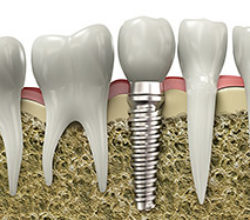 denta implant image 1